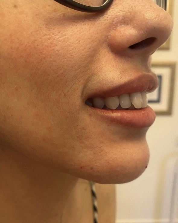 Çene – Jawline Dolgusu